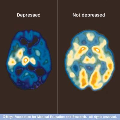MRI Comparison of Depression